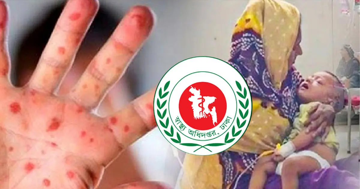 দেশে দেড় মাসে হামে ও উপসর্গে ২৫১ শিশুর মৃত্যু